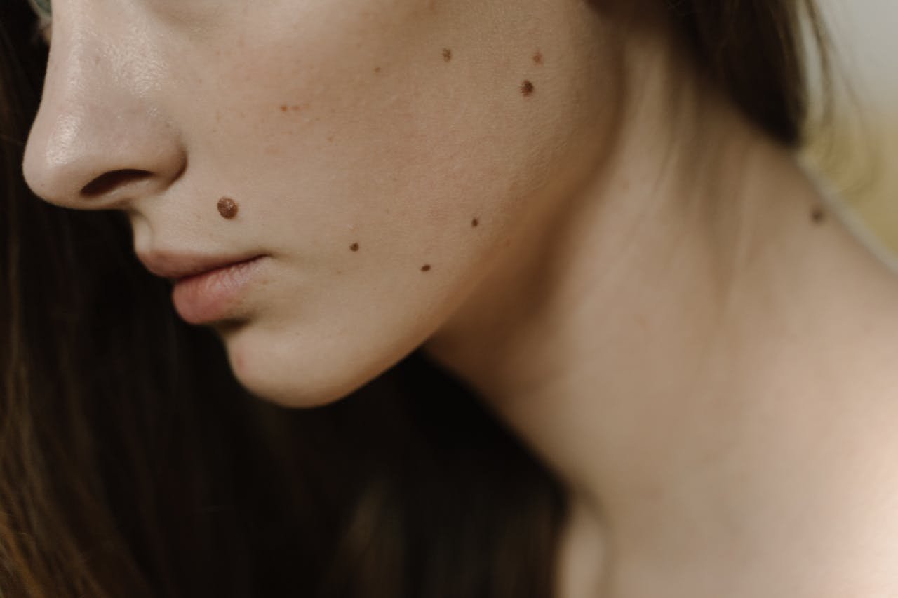 Grain de beauté